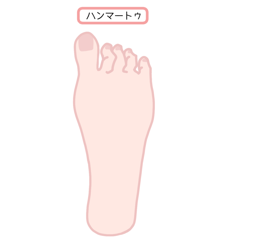 靴の中で足指が曲がる人は要注意。足の変形症「ハンマートゥ」の原因・対処法について説明します